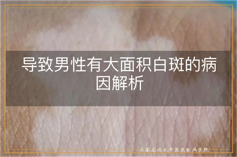 导致男性有大面积白斑的病因解析