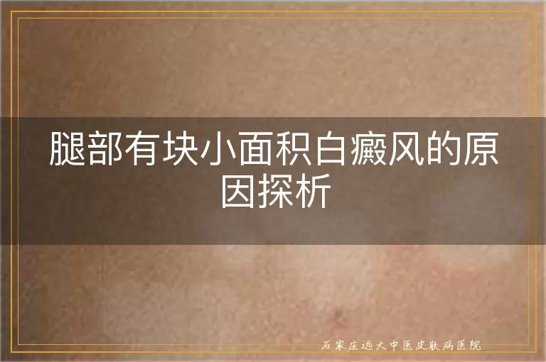腿部有块小面积白癜风的原因探析