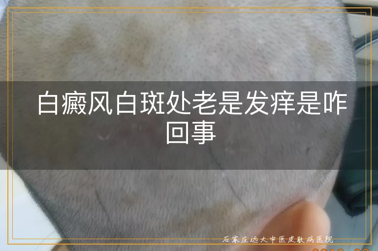 白癜风白斑处老是发痒是咋回事