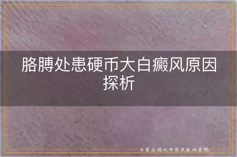 胳膊处患硬币大白癜风原因探析
