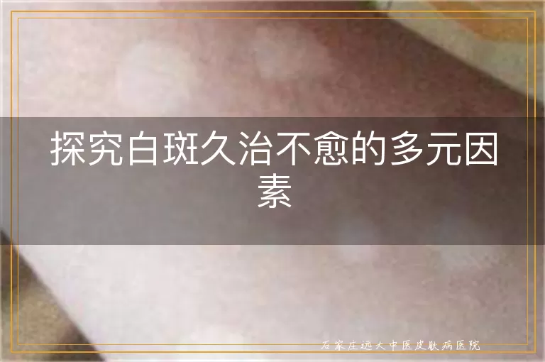 探究白斑久治不愈的多元因素