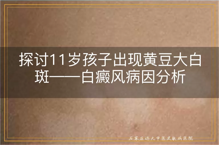 探讨11岁孩子出现黄豆大白斑——白癜风病因分析