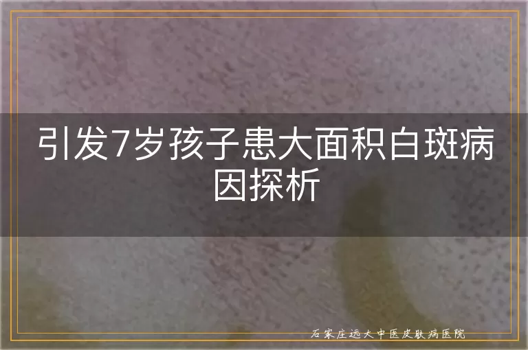 引发7岁孩子患大面积白斑病因探析