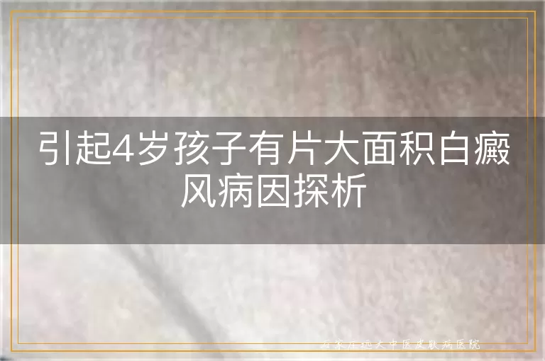 引起4岁孩子有片大面积白癜风病因探析