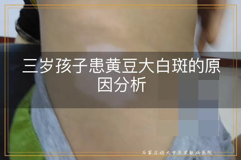 三岁孩子患黄豆大白斑的原因分析