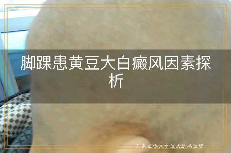 脚踝患黄豆大白癜风因素探析