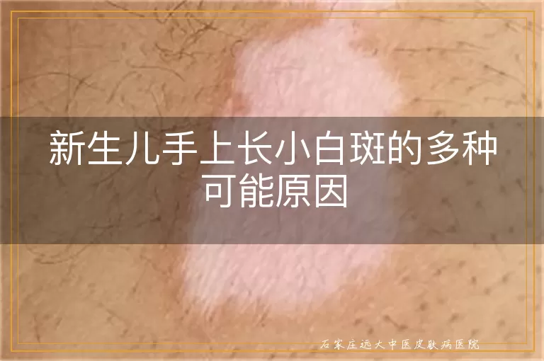 新生儿手上长小白斑的多种可能原因