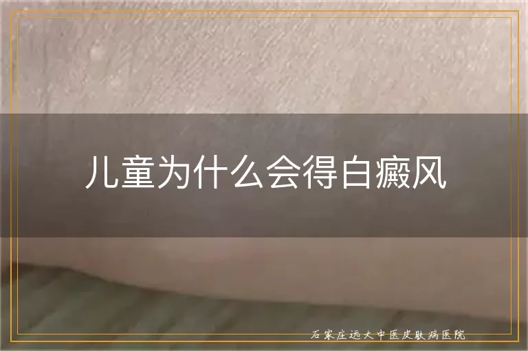 儿童为什么会得白癜风