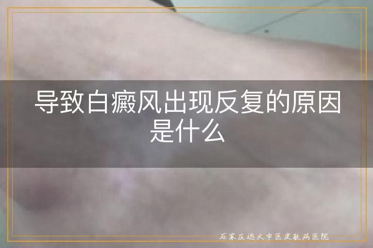 导致白癜风出现反复的原因是什么