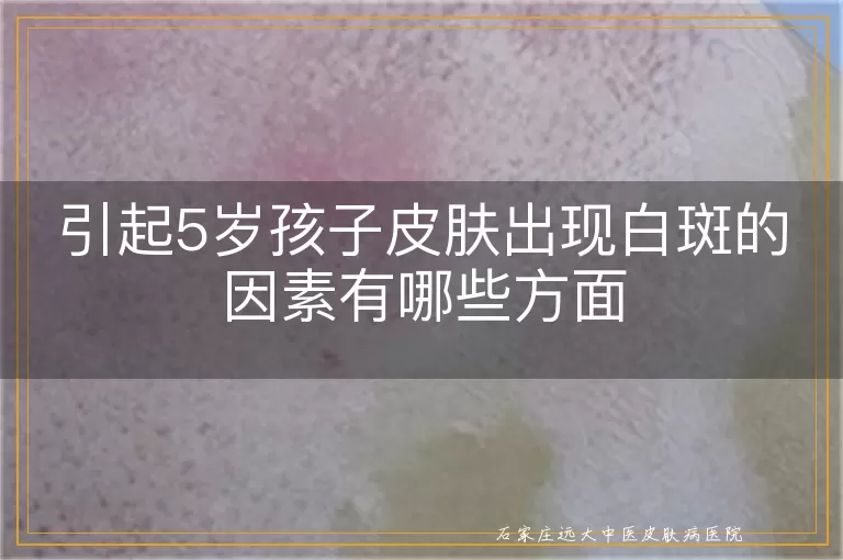 引起5岁孩子皮肤出现白斑的因素有哪些方面