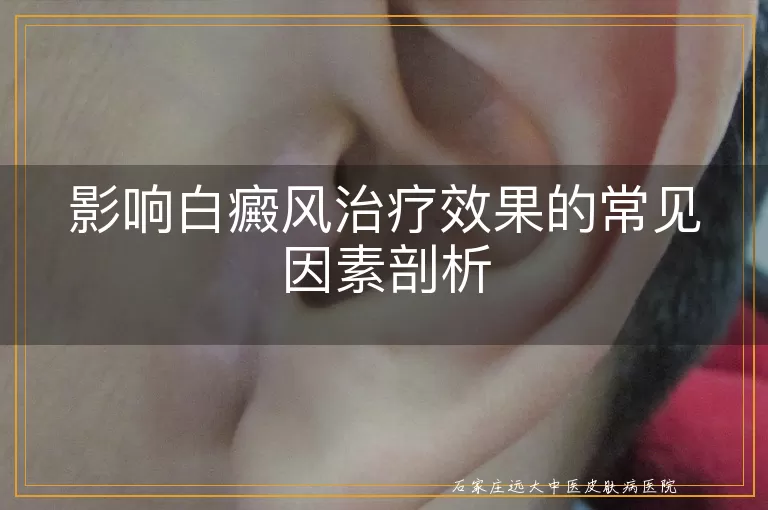 影响白癜风治疗效果的常见因素剖析