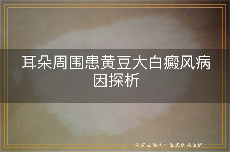 耳朵周围患黄豆大白癜风病因探析