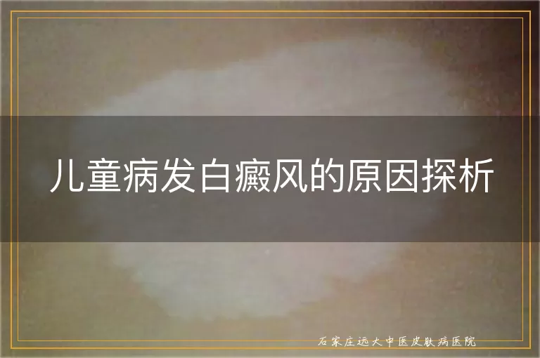 儿童病发白癜风的原因探析