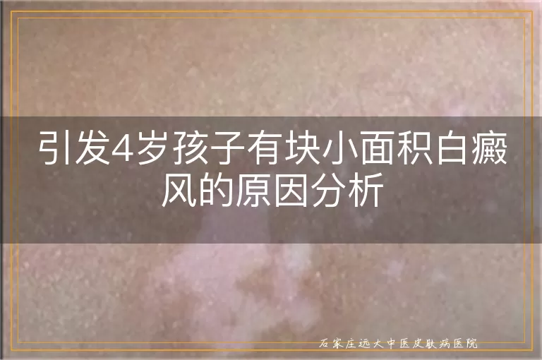 引发4岁孩子有块小面积白癜风的原因分析