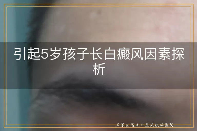 引起5岁孩子长白癜风因素探析