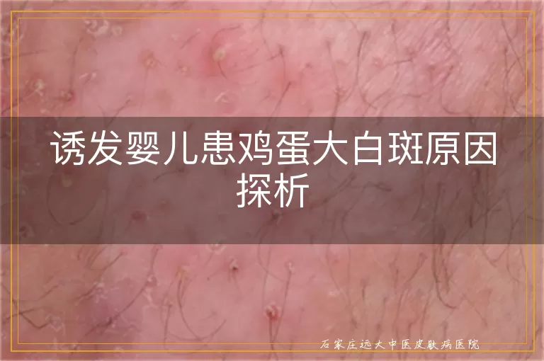 诱发婴儿患鸡蛋大白斑原因探析