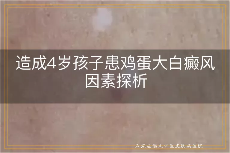 造成4岁孩子患鸡蛋大白癜风因素探析