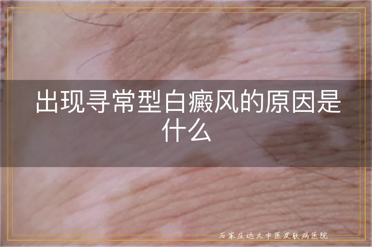 出现寻常型白癜风的原因是什么