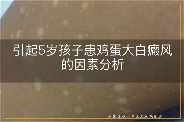 引起5岁孩子患鸡蛋大白癜风的因素分析
