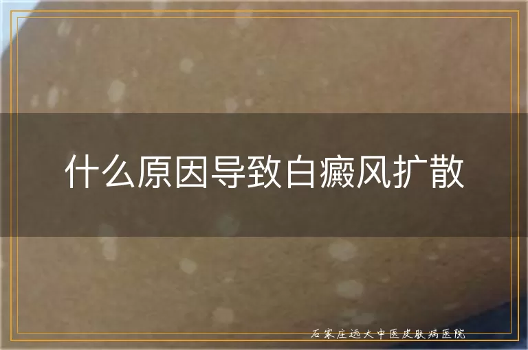 什么原因导致白癜风扩散