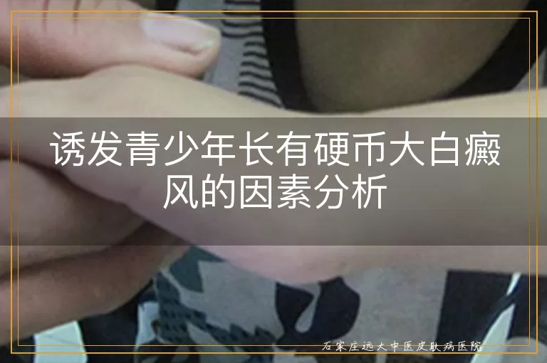 诱发青少年长有硬币大白癜风的因素分析