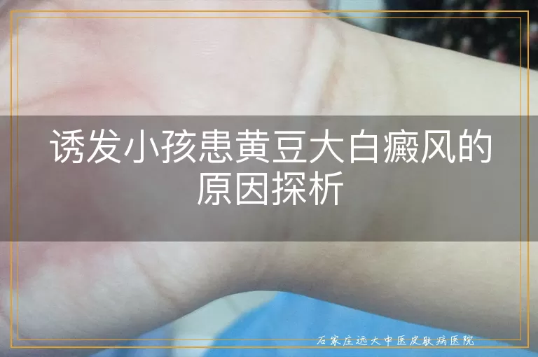 诱发小孩患黄豆大白癜风的原因探析