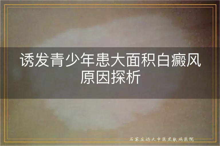 诱发青少年患大面积白癜风原因探析
