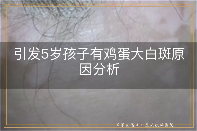 引发5岁孩子有鸡蛋大白斑原因分析