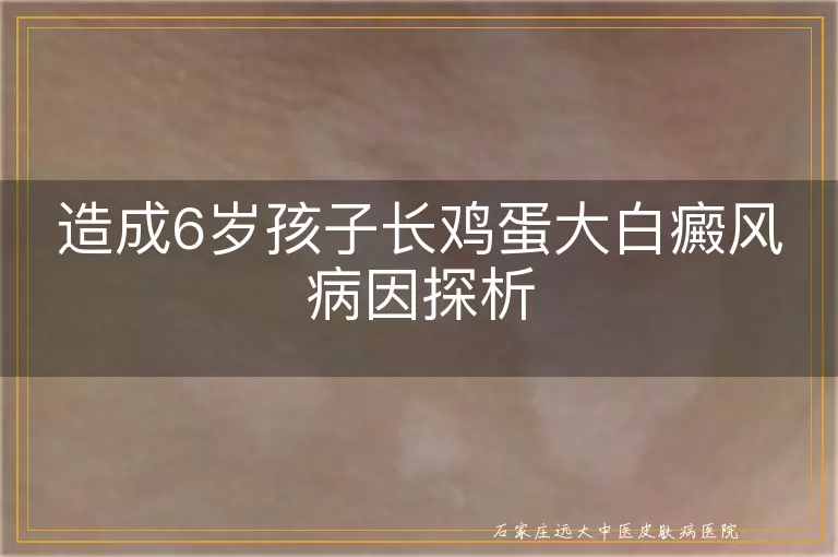 造成6岁孩子长鸡蛋大白癜风病因探析