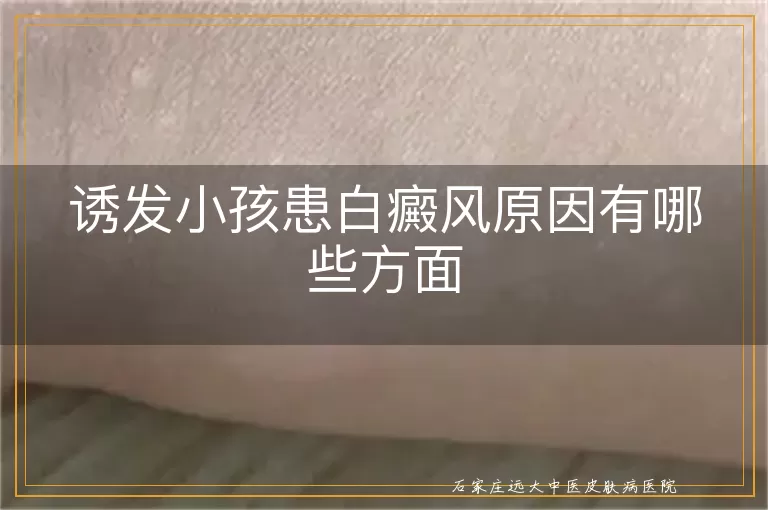 诱发小孩患白癜风原因有哪些方面
