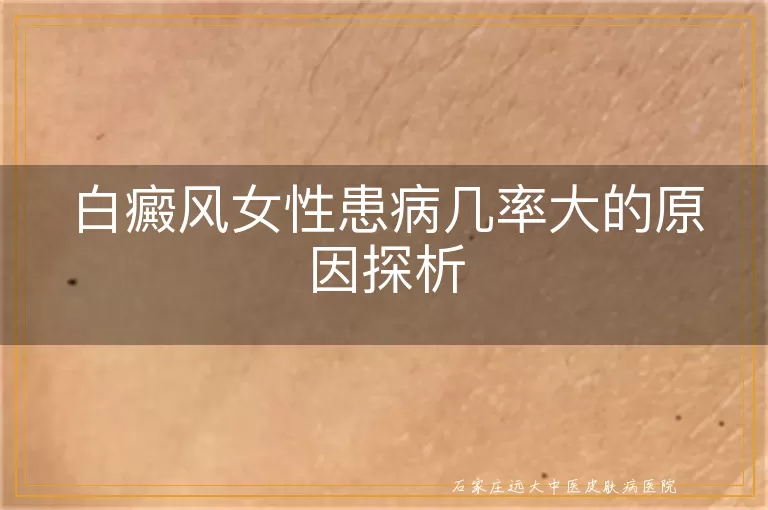 白癜风女性患病几率大的原因探析