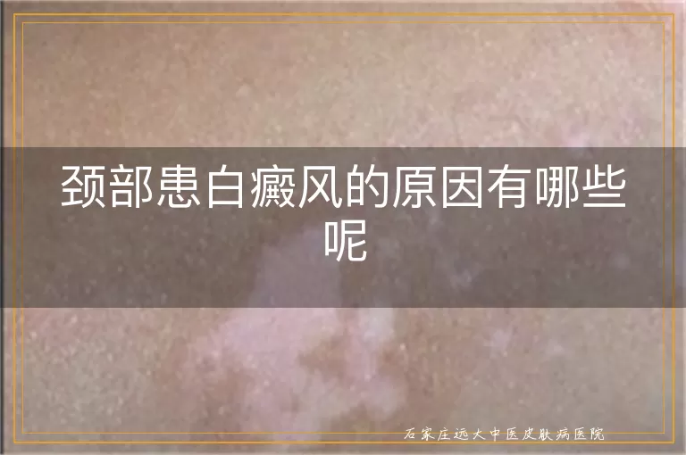 颈部患白癜风的原因有哪些呢