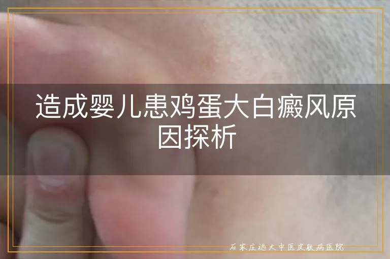 造成婴儿患鸡蛋大白癜风原因探析