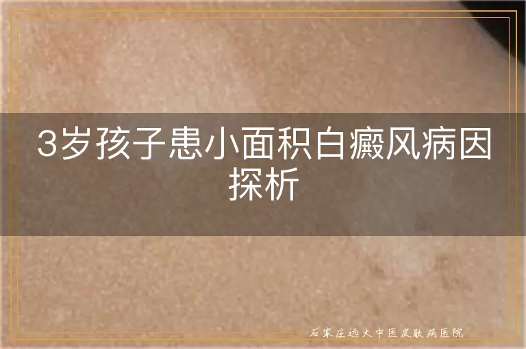 3岁孩子患小面积白癜风病因探析