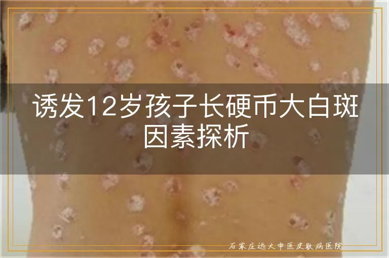 诱发12岁孩子长硬币大白斑因素探析