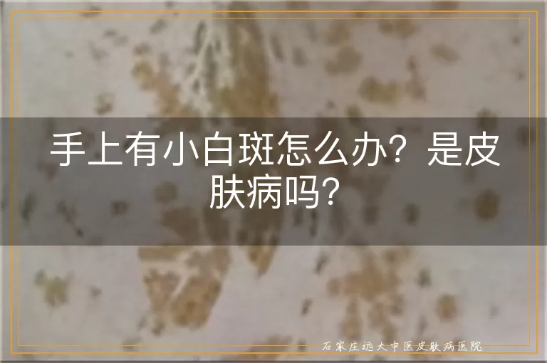 手上有小白斑怎么办？是皮肤病吗？