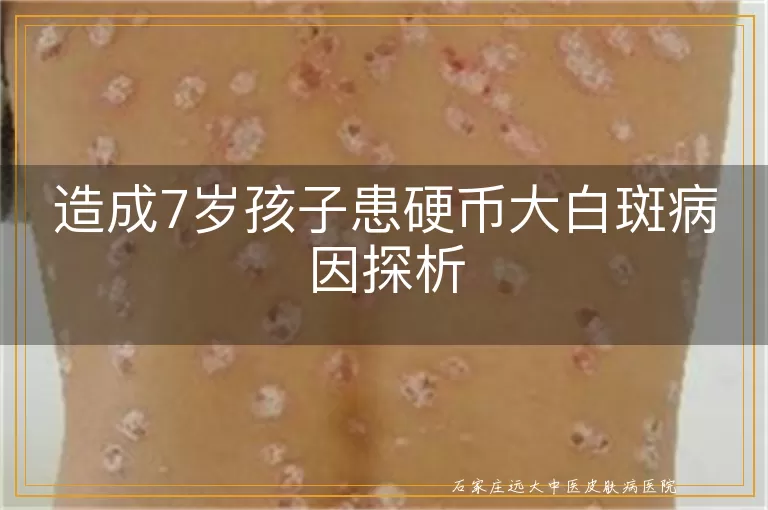 造成7岁孩子患硬币大白斑病因探析