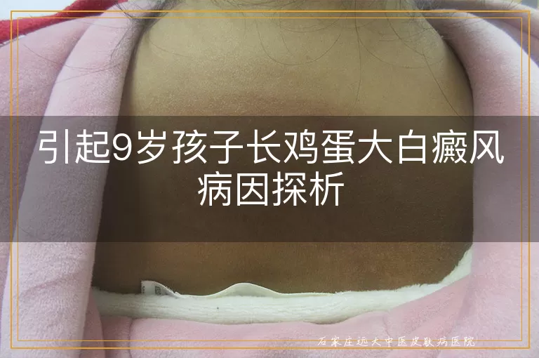 引起9岁孩子长鸡蛋大白癜风病因探析