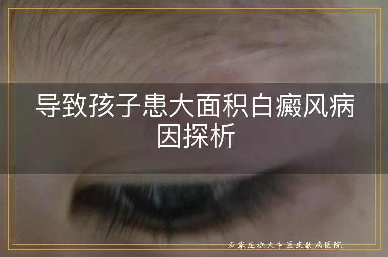 导致孩子患大面积白癜风病因探析