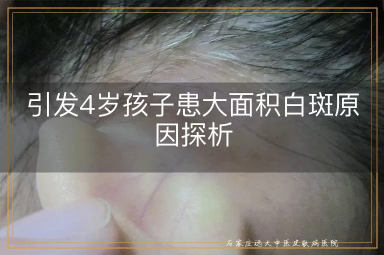 引发4岁孩子患大面积白斑原因探析