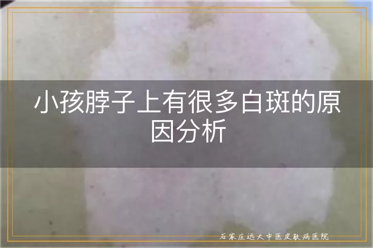 小孩脖子上有很多白斑的原因分析