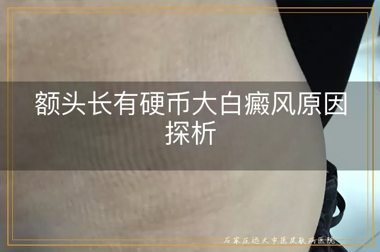 额头长有硬币大白癜风原因探析