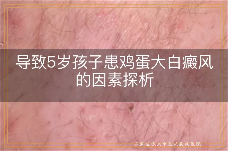 导致5岁孩子患鸡蛋大白癜风的因素探析