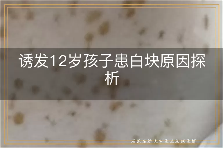 诱发12岁孩子患白块原因探析