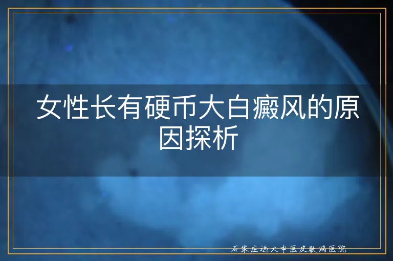 女性长有硬币大白癜风的原因探析