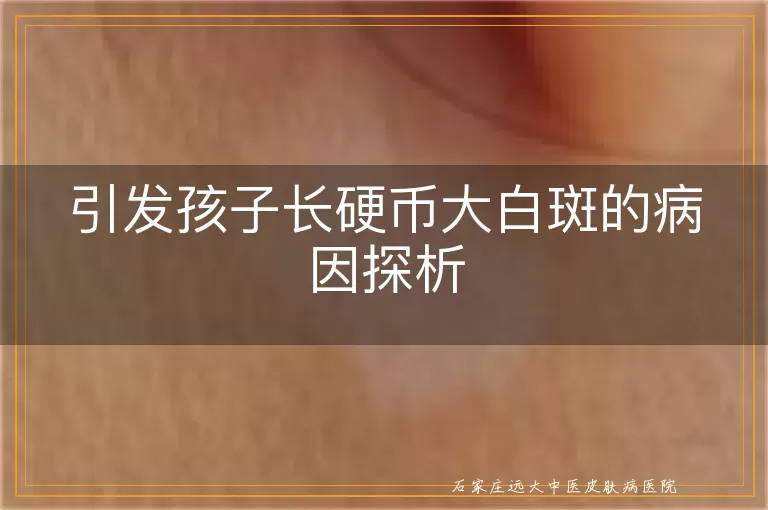 引发孩子长硬币大白斑的病因探析