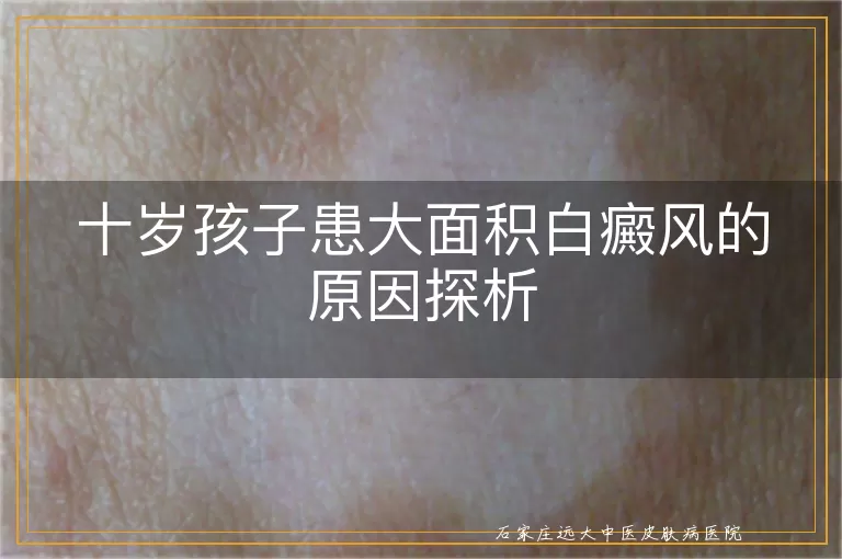 十岁孩子患大面积白癜风的原因探析