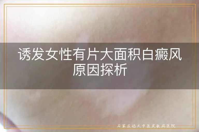 诱发女性有片大面积白癜风原因探析