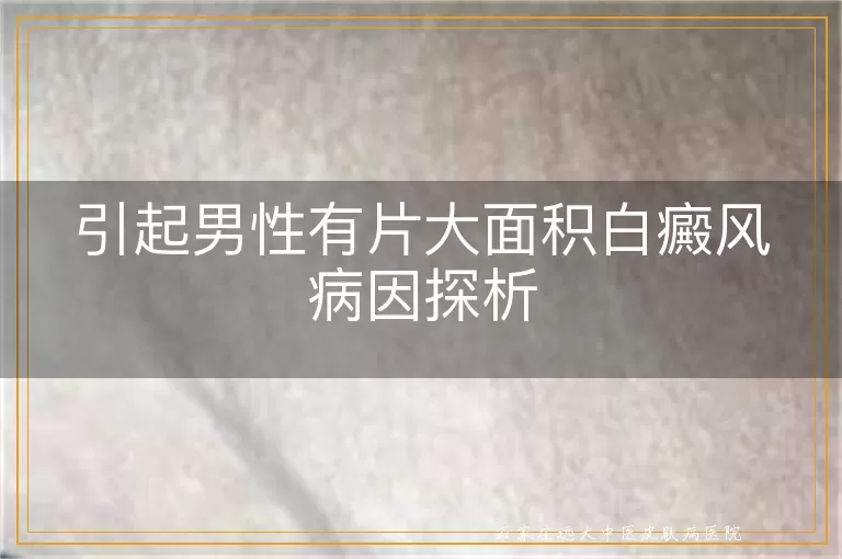 引起男性有片大面积白癜风病因探析