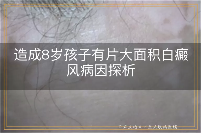 造成8岁孩子有片大面积白癜风病因探析